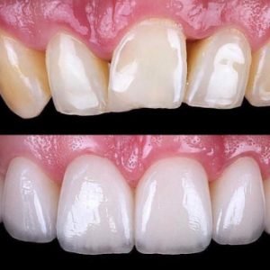 dental-veneers-NYC-before-after (1)